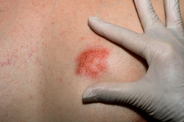 Doctor wear a glove and pointing to Herpes zoster at chest. Detail of skin infected.