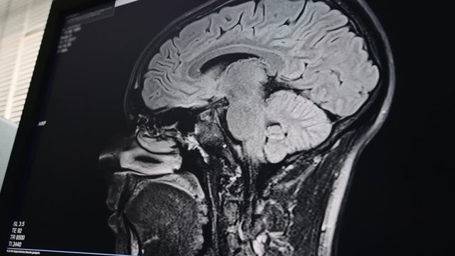 Neurologist shows the Magnetic Resonance Imaging scan results to the patient