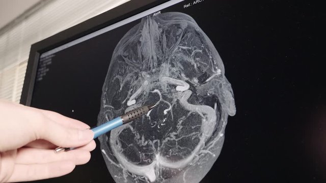 Neurologist pointing his pen and explaining the patient's brain coronal MRI results on a hospital laboratory