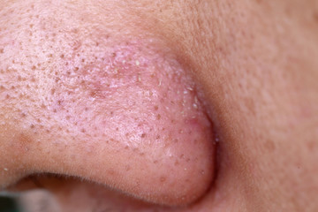 close-up blackheads on the nose