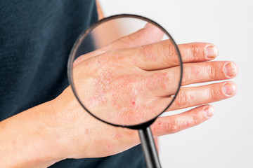 the use of emollient for dry flaky skin, as in the treatment of psoriasis, eczema and other dry...