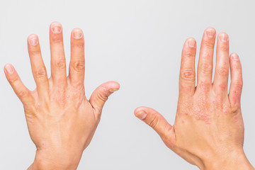 Man with sick hands, dry flaky skin on his hand with vulgar psoriasis, eczema and other skin diseases such as fungus, plaque, rash and blemishes. Autoimmune genetic disease