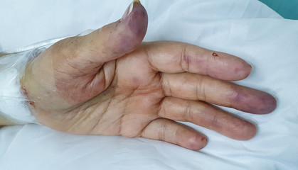 Left hand radial artery partial obstruction