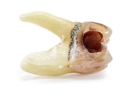 extractive caries tooth isolated on white background close-up macro, upper wisdom molar, shattered tooth filling
