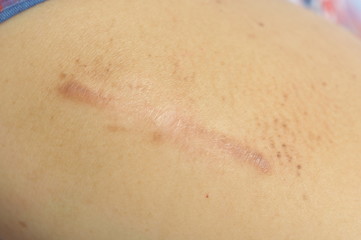 Fototapeta premium scar - a permanent effect on someone’s mind, caused by an unpleasant experience that they have had a permanent mark onwhere have been injured