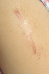 Fototapeta premium scar - a permanent effect on someone’s mind, caused by an unpleasant experience that they have had a permanent mark onwhere have been injured