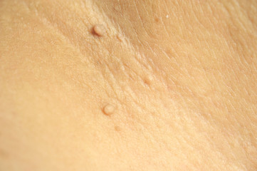 Pedunculated Mass skin tag or acrochondon or soft fibroma. Papilloma bump on male body macro shot on the Thigh
