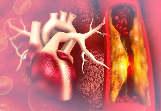 Cholesterol plaque in artery with Human heart anatomy. 3d illustration