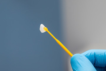 ceramic crowns veneers on a gypsum model of human teeth close-up macro in the dentist's hand in a blue glove.