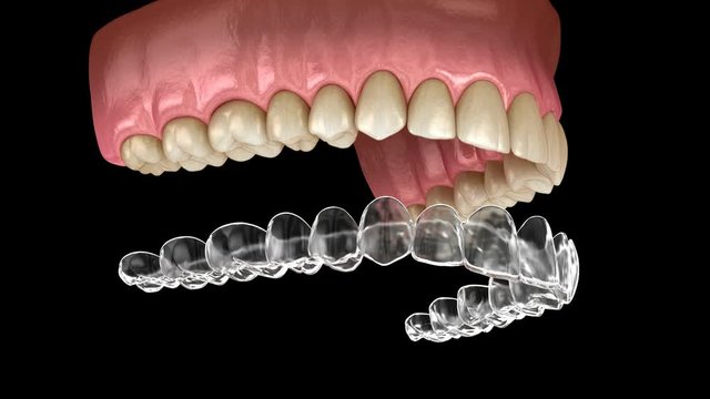 Teeth whitening with Invisalign braces or invisible retainer. 3D animation