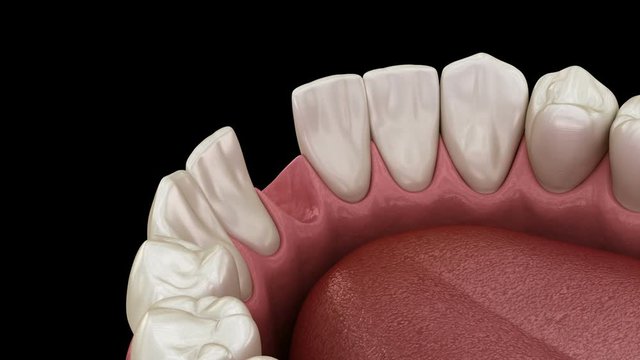 Maryland bridge made from ceramic, front tooth recovery. Medically accurate 3D animation of dental concept