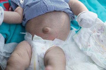 Newborn baby navel break, hernia in babies
