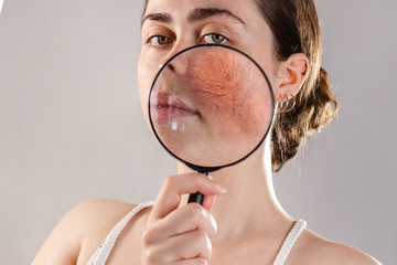 Cosmetology and rosacea. A young woman holds a magnifying glass near her face, showing the inflamed...