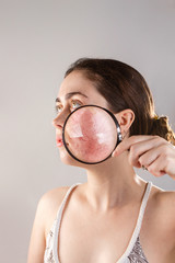 Cosmetology and rosacea. A young woman holds a magnifying glass near her face, showing the inflamed...
