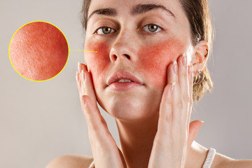 Cosmetology and rosacea. A young woman holds her hands to her reddened, inflamed rosacea cheeks....