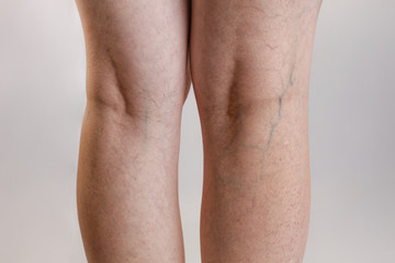 Varicose veins and medicine. Female legs close - up with vessels and the initial stage of varicose...