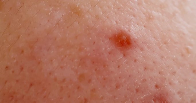 acne on the woman face