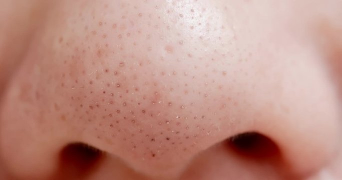 blackheads on woman nose