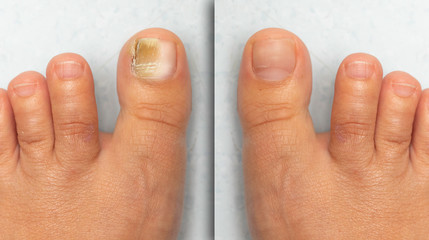 Before and after successful treatment for a fungal infection on toe