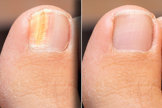 Before and after successful treatment for a fungal infection on toenail