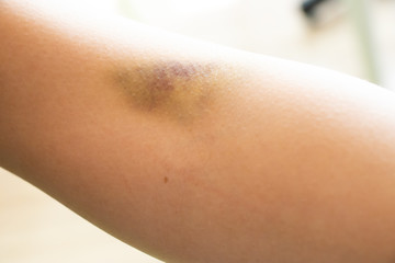 Bruise injury on the female arm background