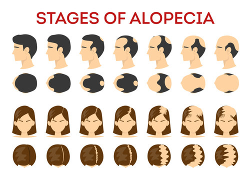 Alopecia stages set. Hair loss, balding process. Female
