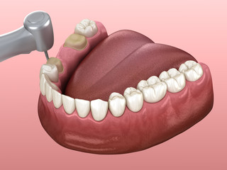 Premolar preparation process for dental crown placement. Medically accurate 3D illustration