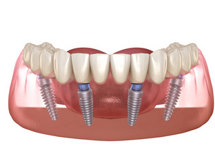 Fototapeta na wymiar Mandibular prosthesis All on 4 system supported by implants. Medically accurate 3D illustration of human teeth and dentures concept