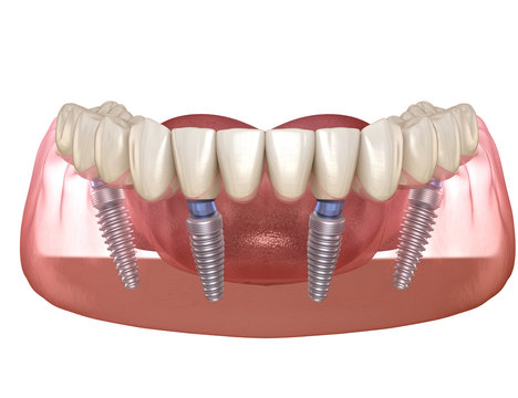 Mandibular prosthesis All on 4 system supported by implants. Medically accurate 3D illustration of human teeth and dentures concept