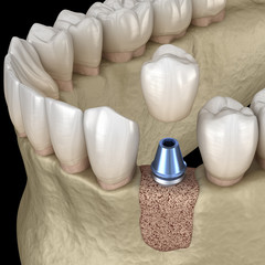 Fototapeta na wymiar Augmentation Surgery - Adding new bone. 3D illustration