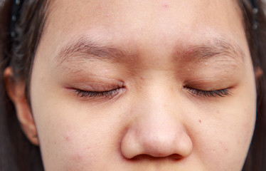 Problems facial skin is acne and blemishes.