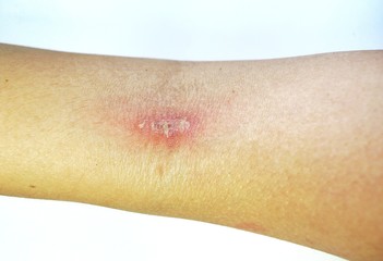Inflammatory purulent dermatitis caused by allergies and sheep scratching
