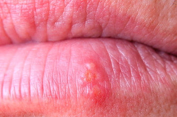 Fototapeta premium Herpes virus on the lower lip of an adult male close-up