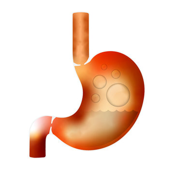 Gas pain & acid reflux