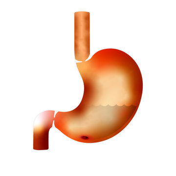 Peptic ulcer