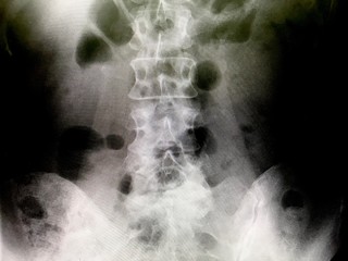 ヘルニアと診断された40代女性の腰のレントゲン写真