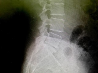 ヘルニアと診断された40代女性の腰のレントゲン写真