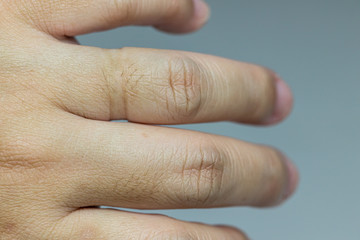 Ring wound in the right hand on the finger. Part of a human hand where one finger has marks of a...