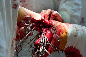 Leg Amputation Surgery Detail