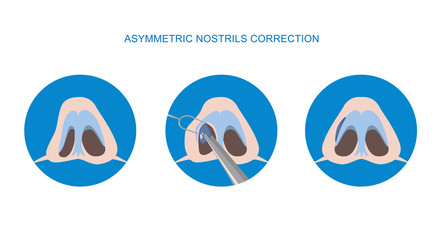 Correction of asymmetric nostrils. Rhinoplasty surgery vector. Implant. Vector illustration.