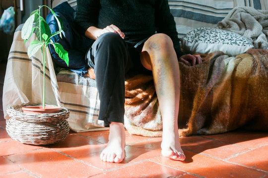 woman with a large hematoma on her leg