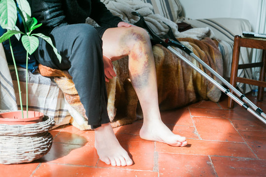 woman with a large hematoma on her leg