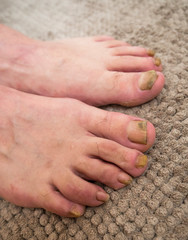 Onychomycosis with fungal nail infection two feet.