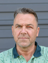 Middle-aged man with swollen inflamed eye