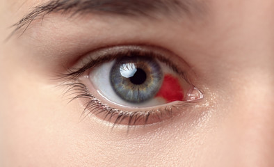 Bloodshot eye. Woman with burst blood vessel in eye. Very red bloody eyeball. Bleeding damage in...