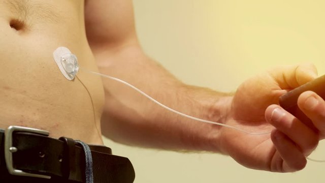 Diabetic man with an insulin pump connected in his abdomen and holding the insulin pump at his hands. Diabetes concept.