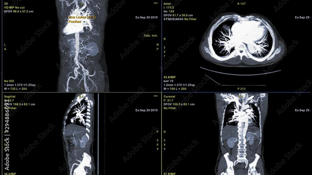 Poster cta whole aorta 3d rendering image comparison with axial, coronal and sagittal view.