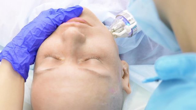 close-up. microneedle RF lifting procedure. Hardware cosmetology. Beautician conducts a facial rejuvenation procedure for a bald woman.
