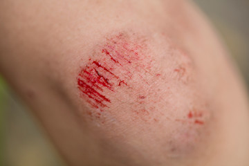 close up wound on knee from accident, healthcare and medicine concept