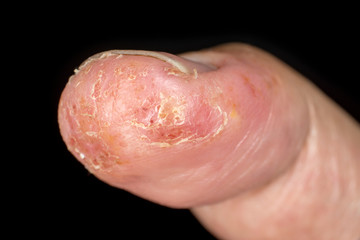Closeup of eczema dermatitis allergic skin rash on male thumb with skin peeling. . Isolated over black background. Macro. Shallow depth of field.